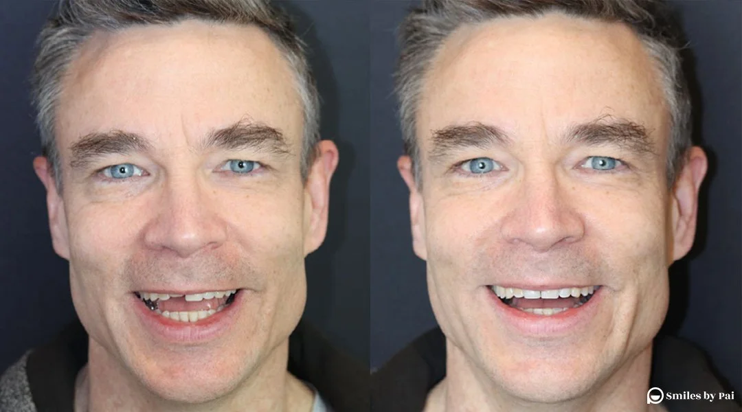 smile makeover_invisalign_bonding.png