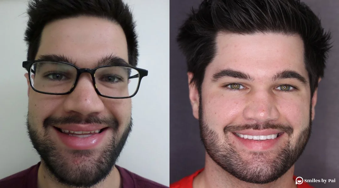 smile makeover_veneers_invisalign_10.jpg