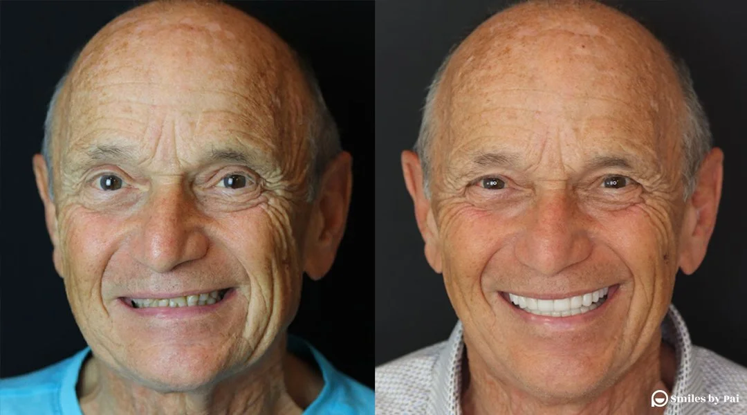 smile makeover_veneers 2.jpeg
