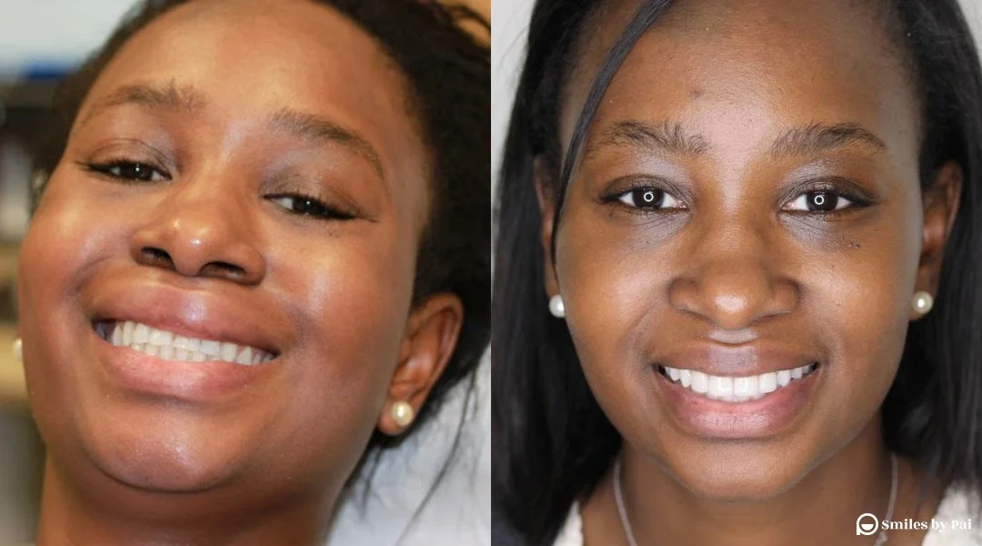 smile makeover_veneers_invisalign_4.jpg