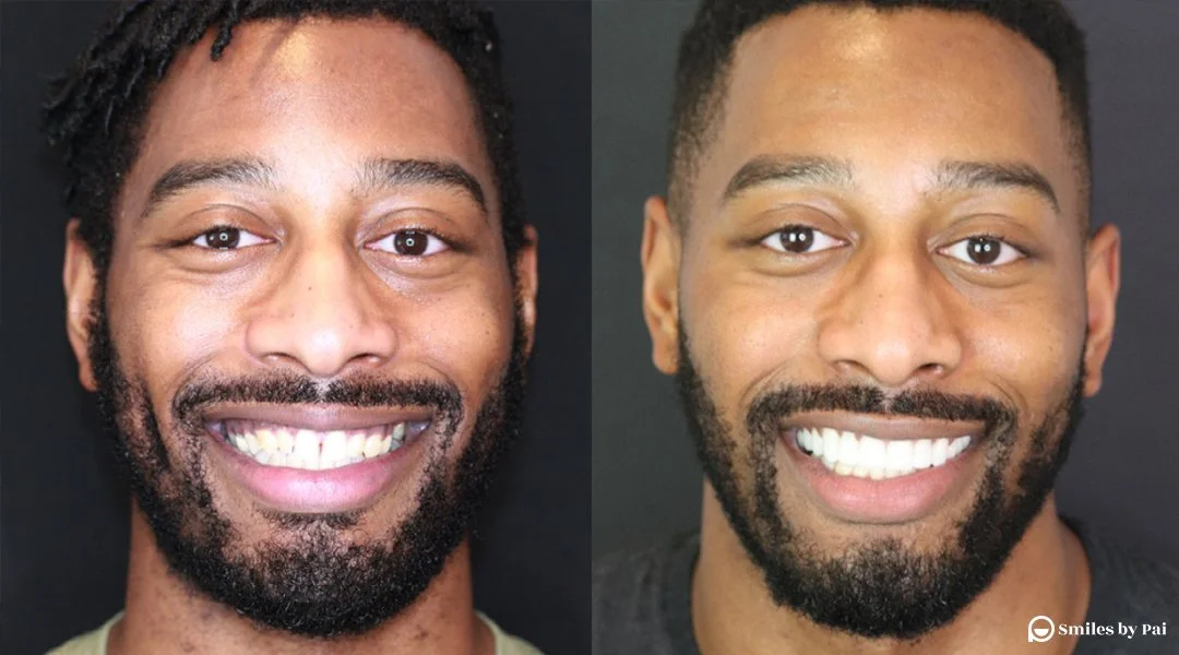 smile makeover_veneers 3.jpeg