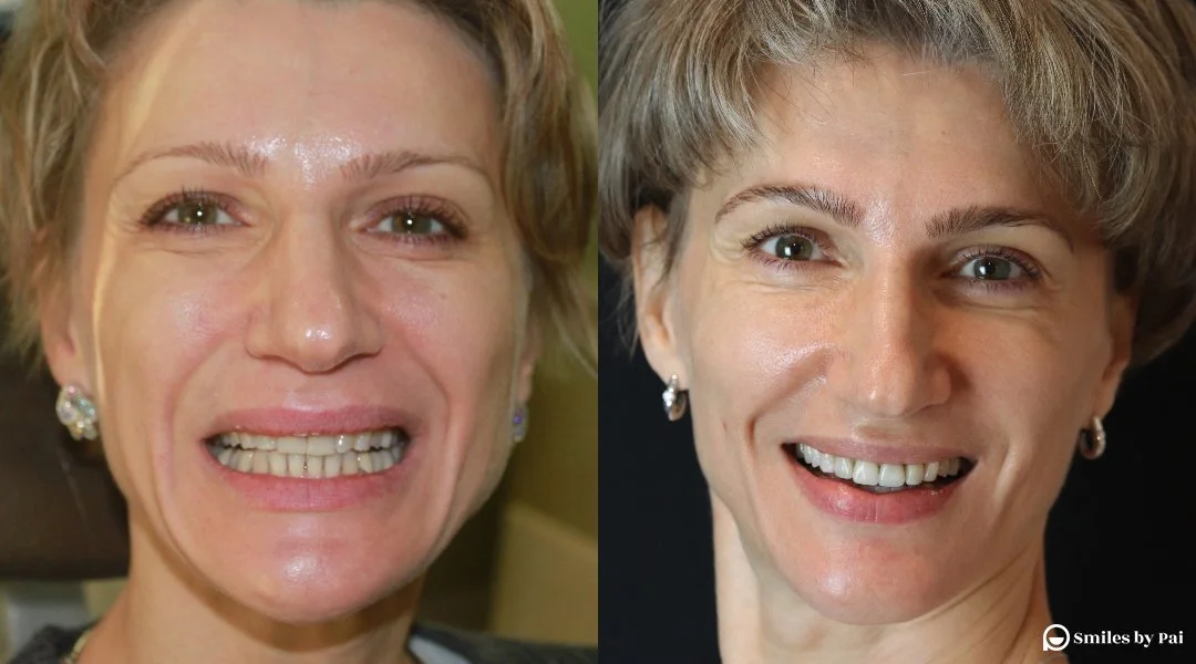 smile makeover_invisalign_2.jpg