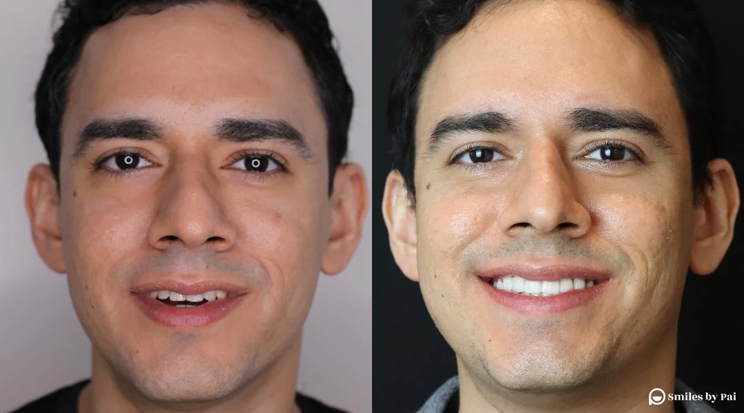 smile makeover_veneers_invisalign_3.jpg