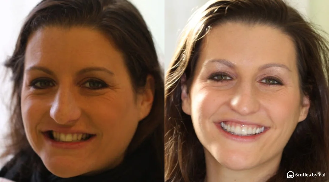 smile makeover_veneers_invisalign_5.jpg