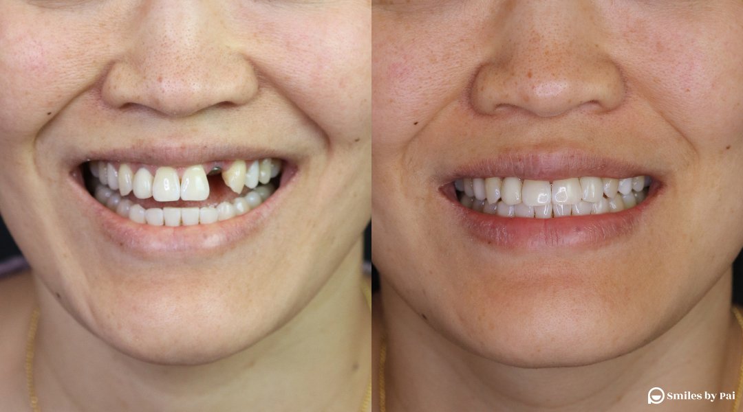 smile makeover_dental implant_3 copy.jpg