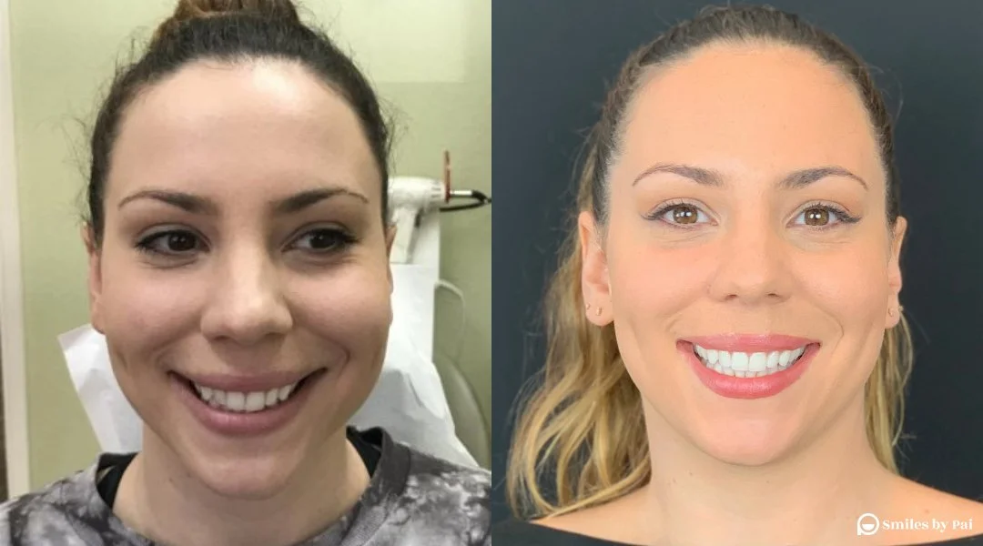 smile makeover_invisalign_1 copy.jpg