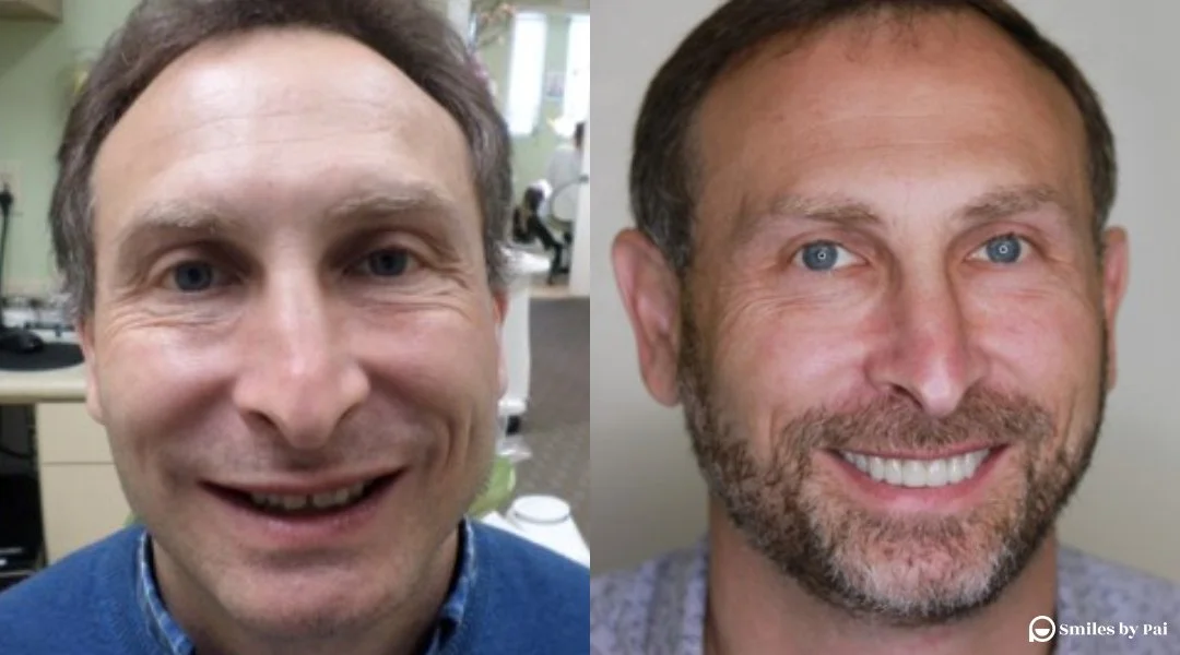 smile makeover_veneers_invisalign_2.jpg