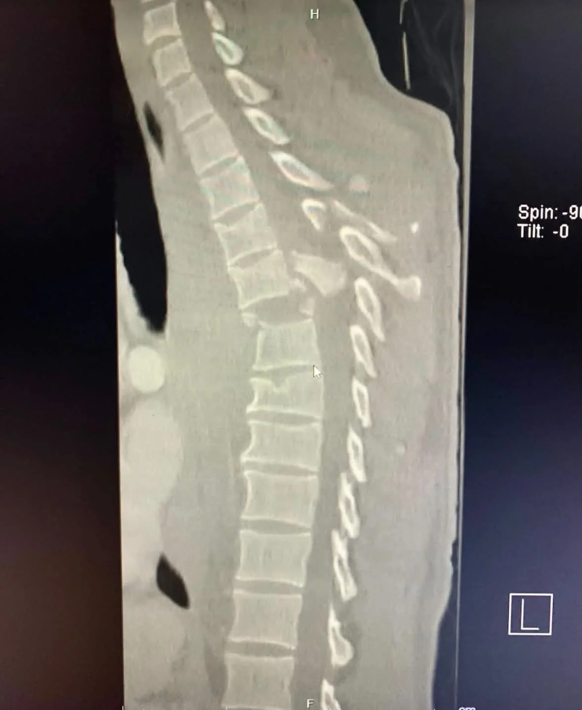 Buyten Spine MRI.jpg