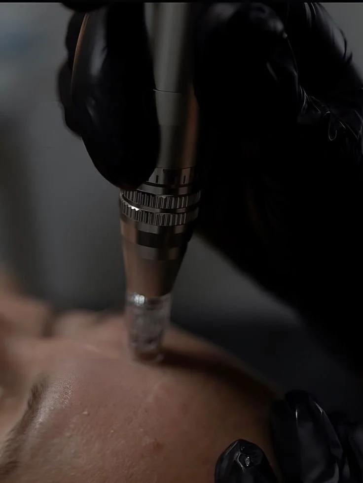 microneedling.JPG