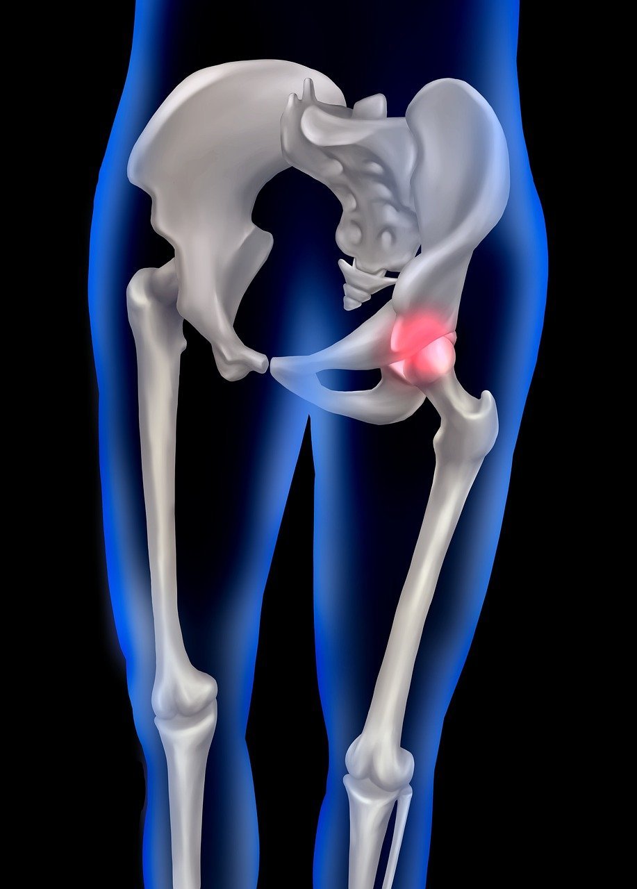 An illustration of a human pelvis and upper leg bones showing a hip joint injury with inflammation, highlighted in red.