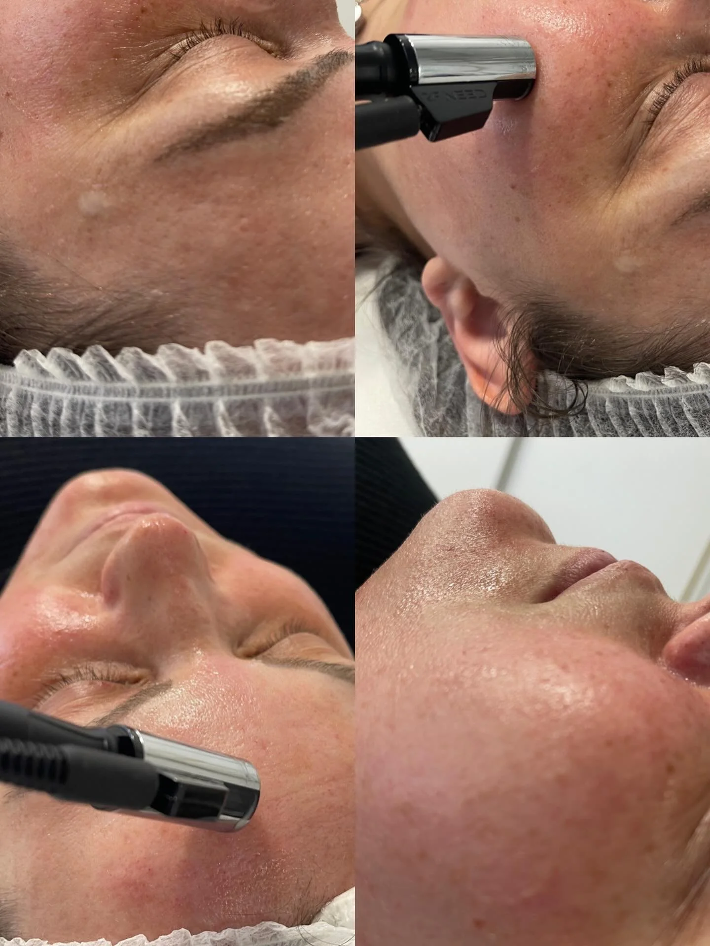 RF microneedling - trenutno najbolj zaželen tretma✨

Zakaj?💫
&bull; Spodbuja intenzivno tvorbo kolagena in elastina
&bull; Izbolj&scaron;a čvrstost in tonus kože
&bull; Zgladi drobne gube in linije
&bull; Zmanj&scaron;a brazgotine po aknah
&bull; Zo