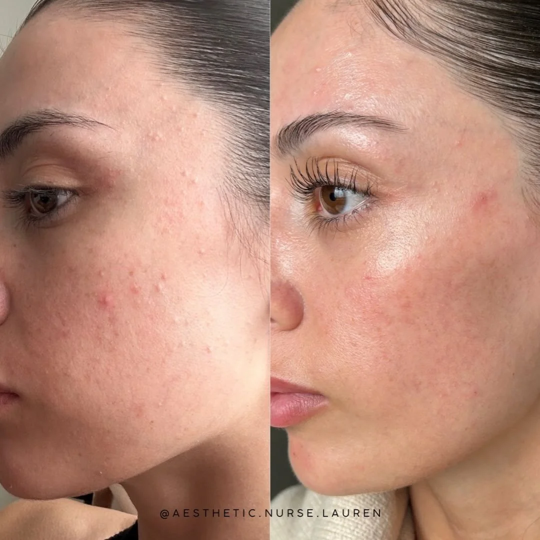 Real revision = real results. 

Following two Signature Treatments utilising DMK professional products and LED therapy, we have successfully reduced congestion, decreased inflammation and improved skin barrier function. The Signature Treatment is per