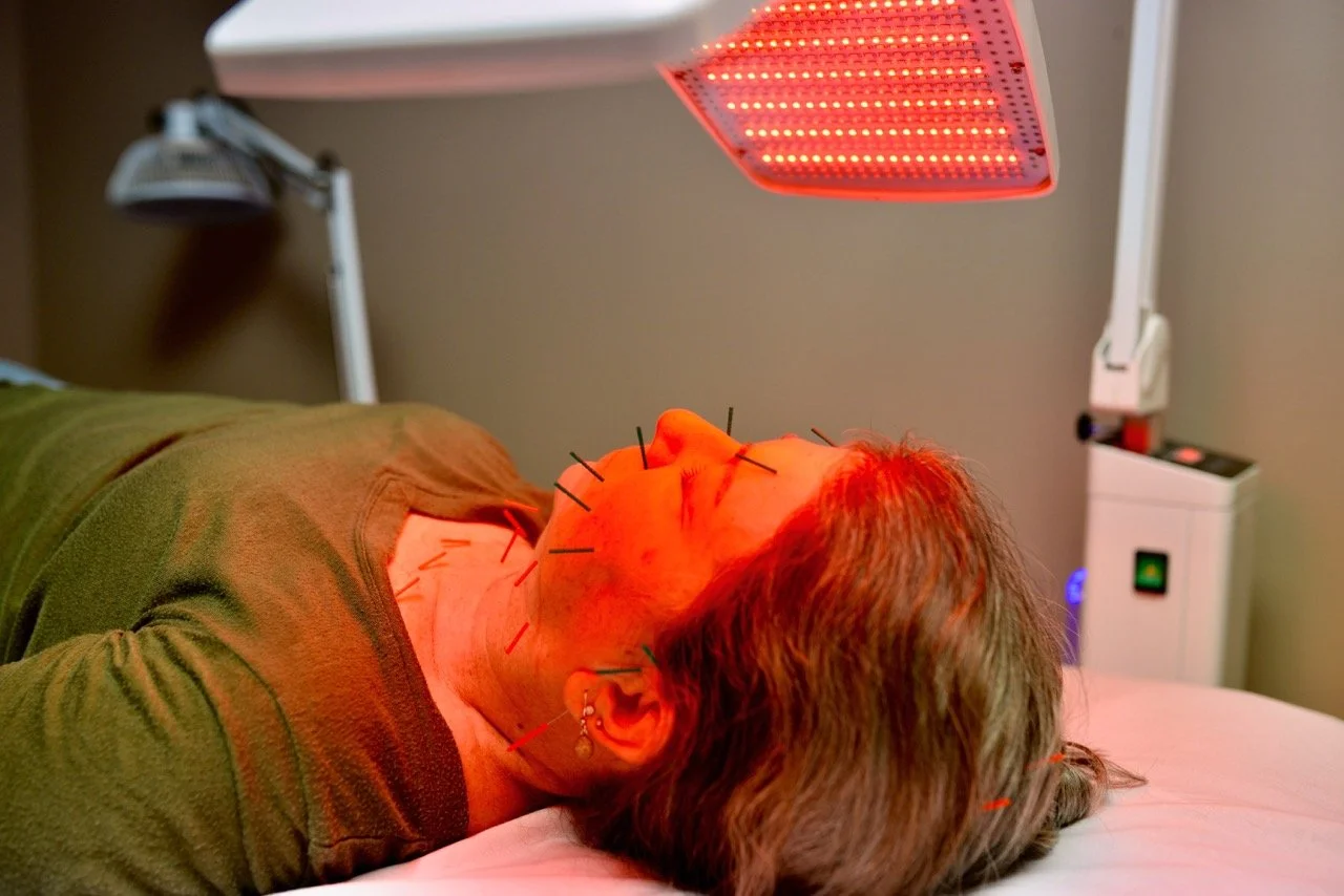 A woman lying on her back under a red infrared heat lamp during acupuncture treatment, with multiple acupuncture needles inserted in her face and neck.