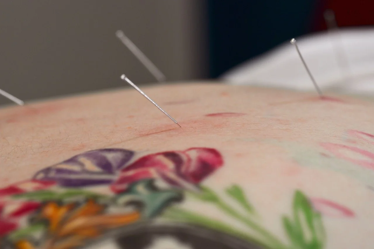 Acupuncture needles inserted into a person's back.