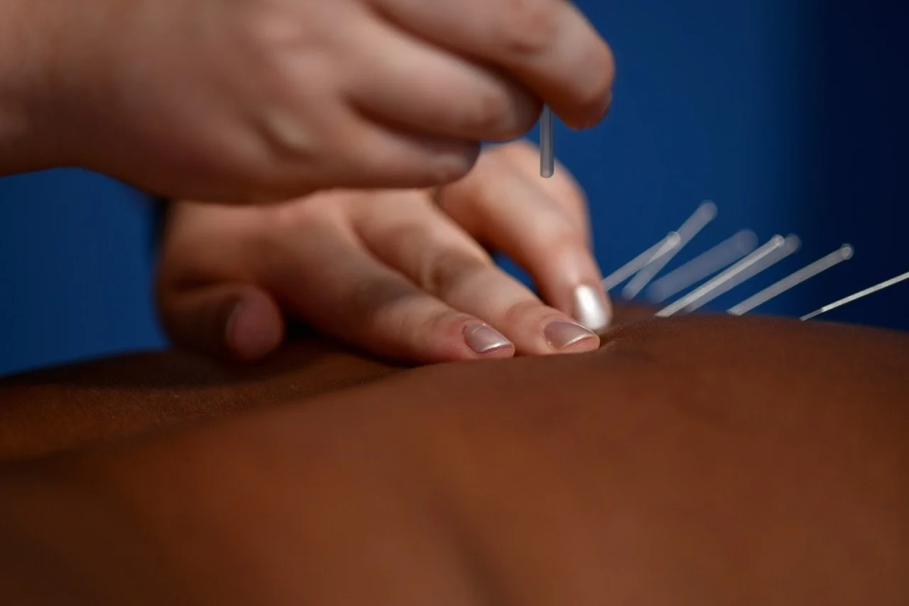 Close-up of an acupuncturist inserting fine needles into a patient's back.