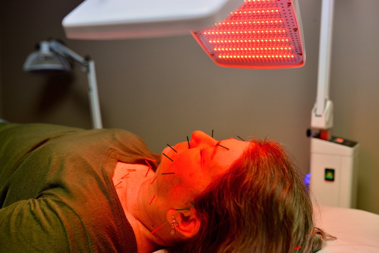 A woman lying on a treatment bed with acupuncture needles inserted into her face. A red light therapy device is above her face, emitting red light.