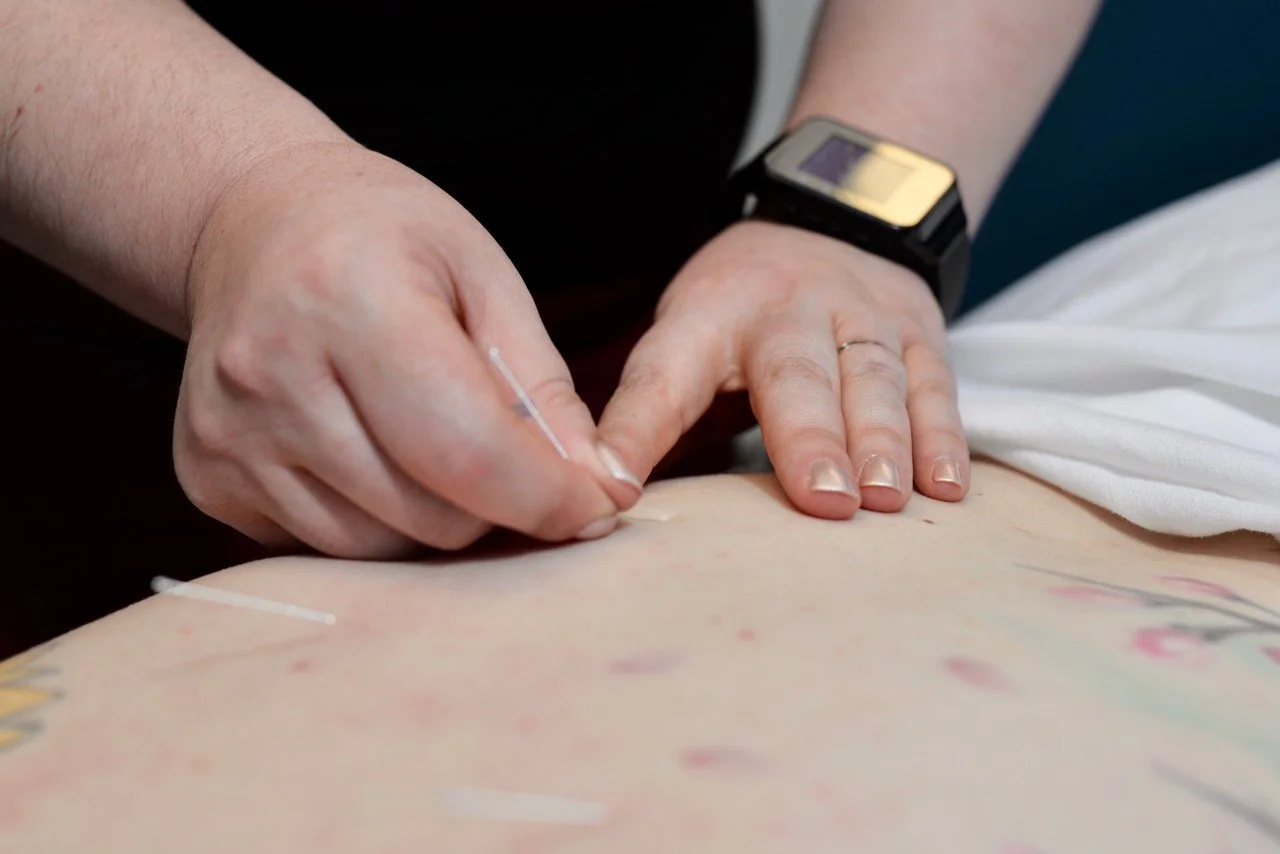 Person administering acupuncture by inserting thin needles into a person's back.