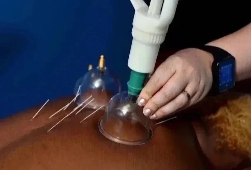 A medical professional is performing cupping therapy using glass cups and a suction device on a person's back.