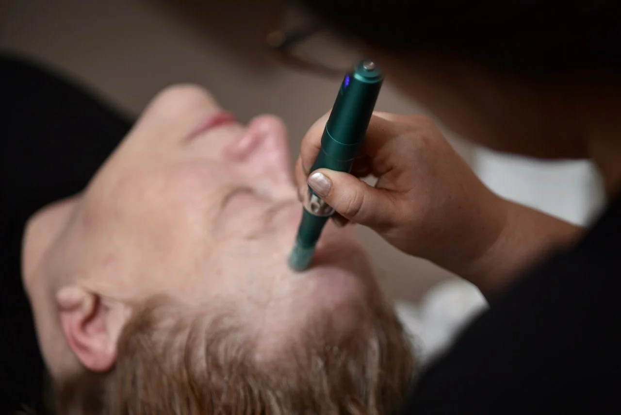 Red Dragon Wellness - Services - Micro-needling Smooth Skin