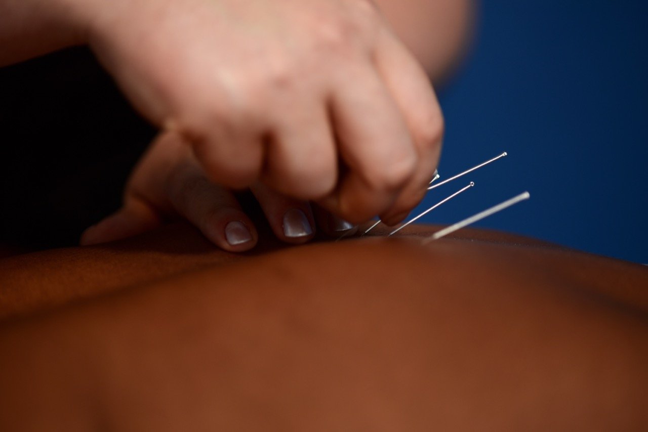 A person performing acupuncture on a patient's back, inserting thin needles.