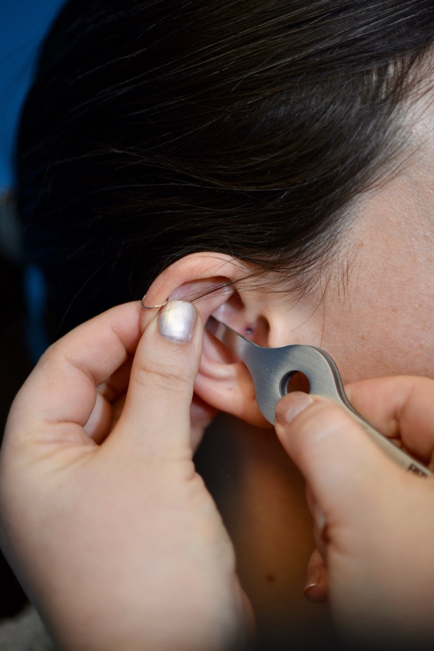 A closeup of a client receiving SAAT treatment by a healthcare professional.