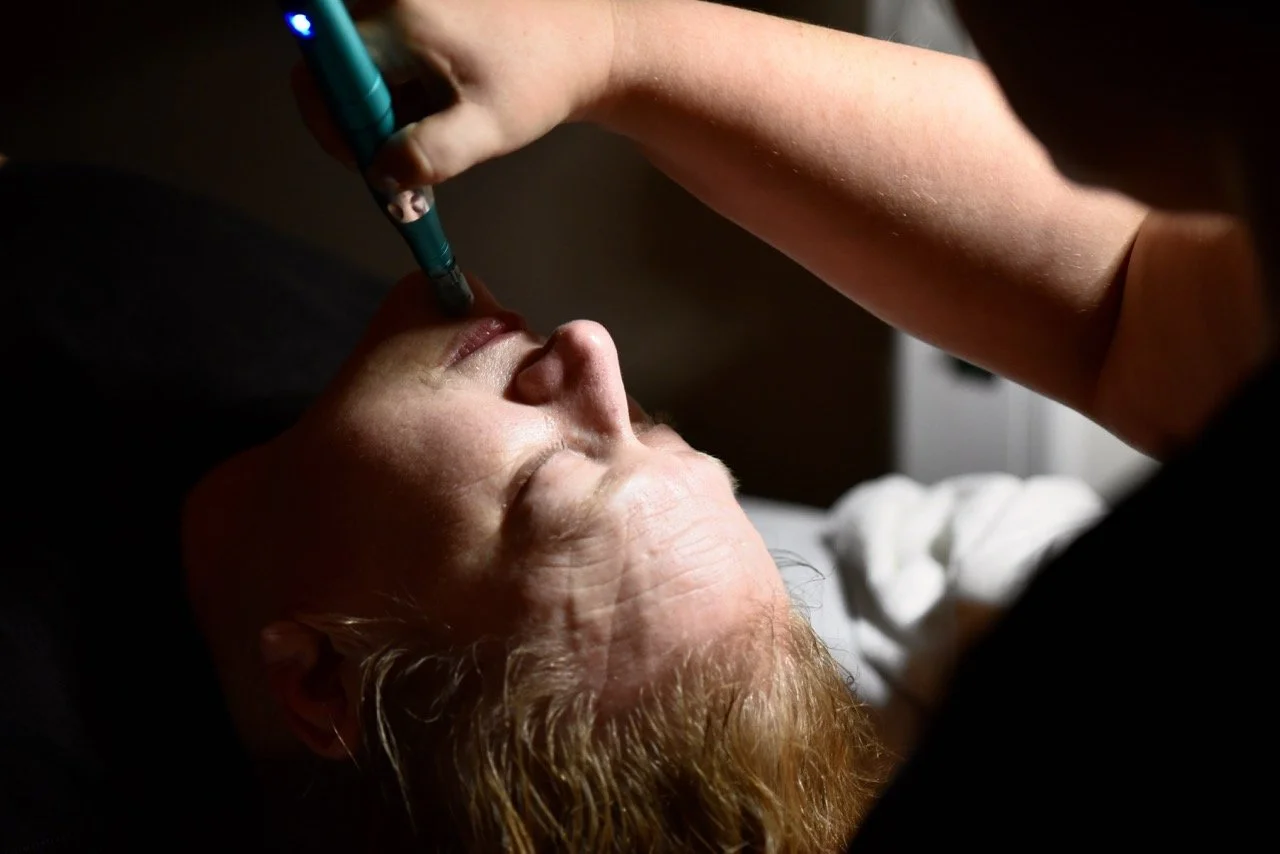A person receiving a micro needling service for smoother skin.