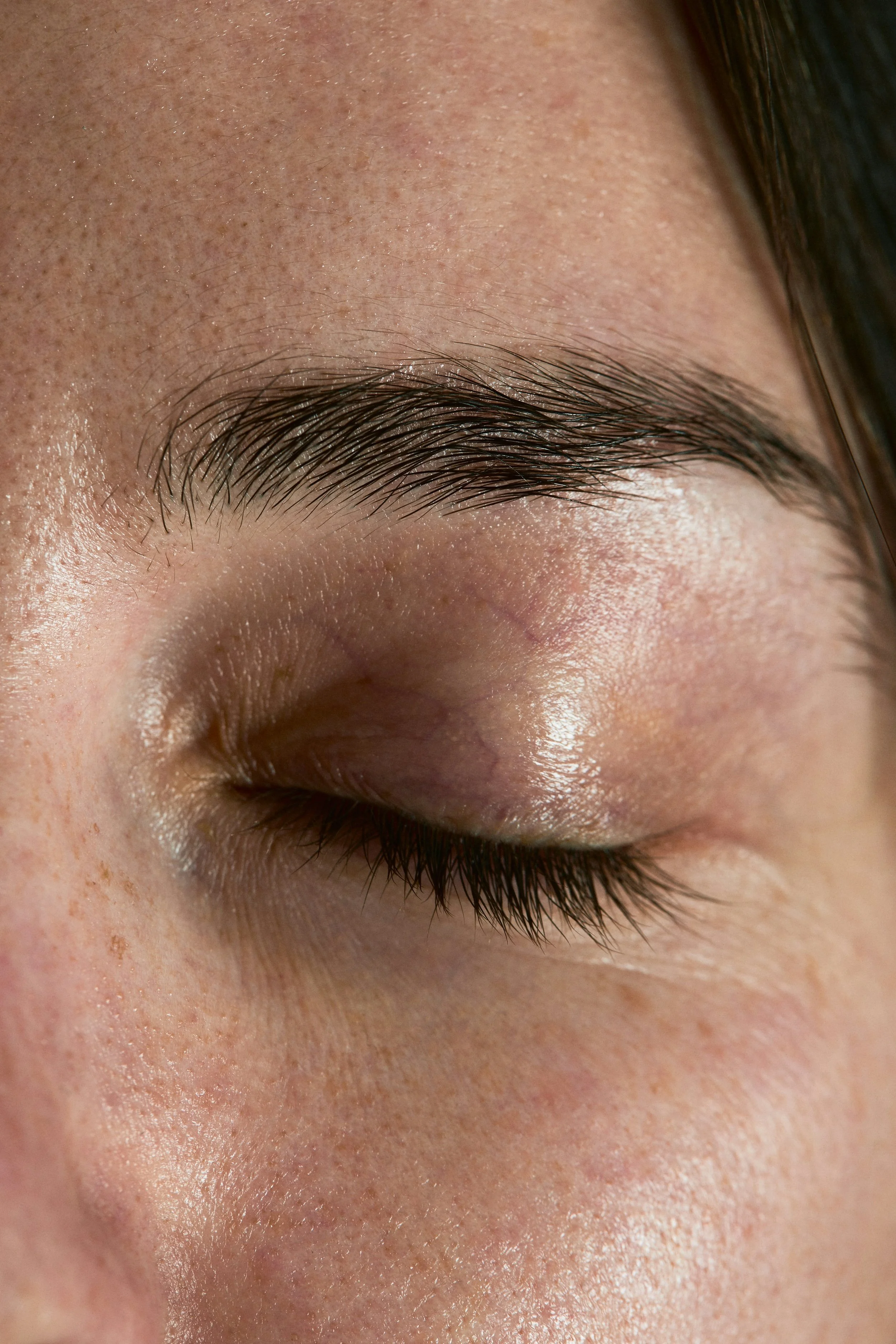 Why Rosacea makes Your Eyes Burn