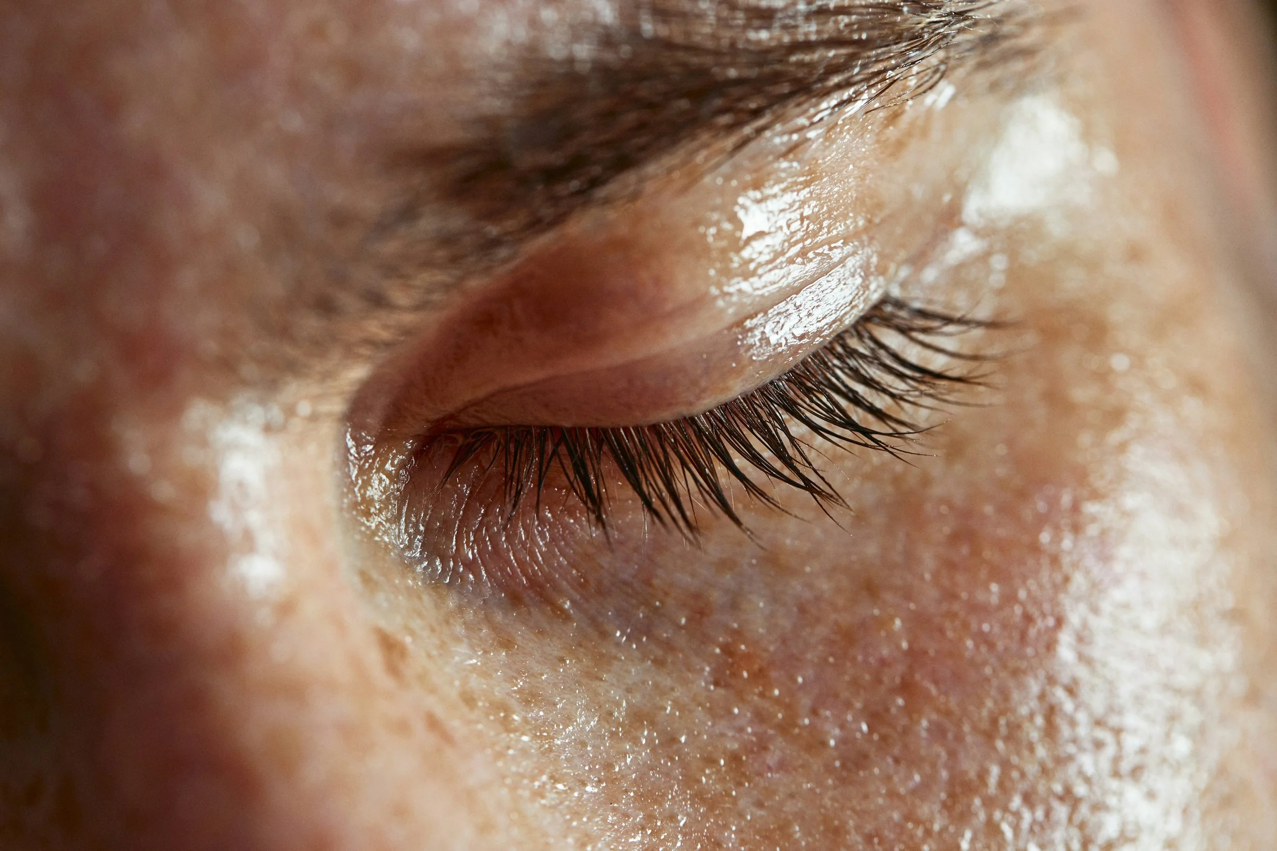 Top Tips for Managing Ocular Rosacea and Dry Eye this Winter