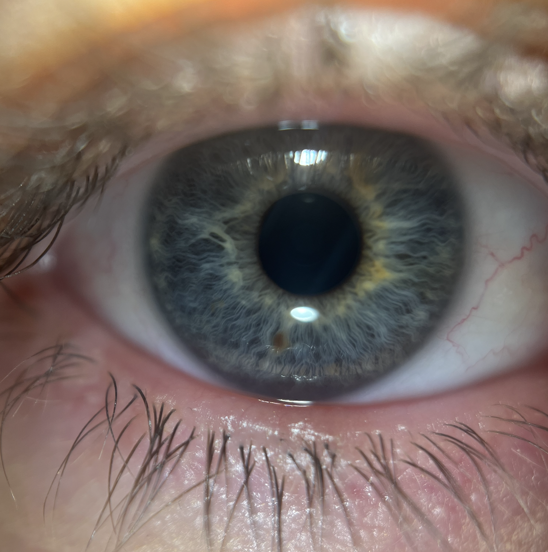 Dry Eye