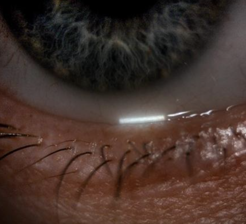 Close-up of an eye with dry eye and ocular roscea and part of the eyelid visible.