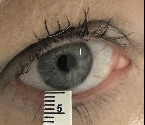Close-up of a human eye with an eye measurement tool showing number 5.