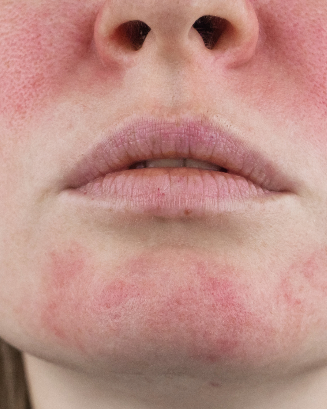 Nahaufnahme eines menschlichen Gesichts, das Nase, Lippen und Kinn zeigt, mit sichtbarer Rötung auf der Wangen- und Kinnregion.