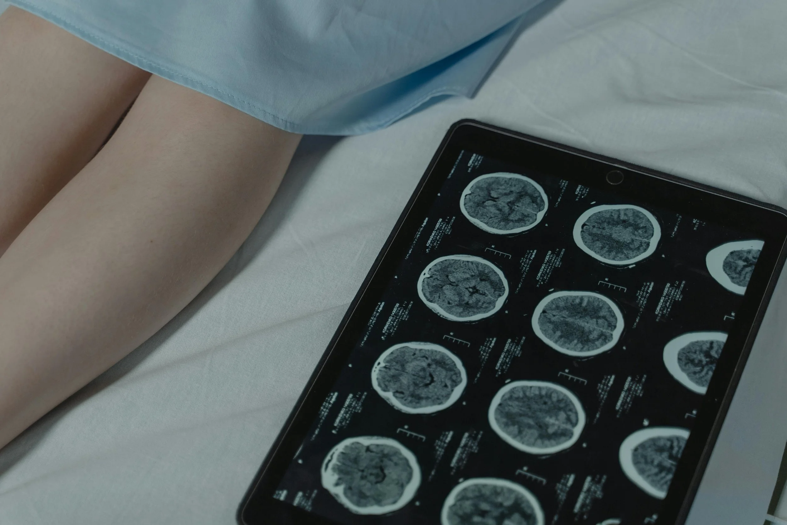 Is Epilepsy Covered Under Health Insurance?