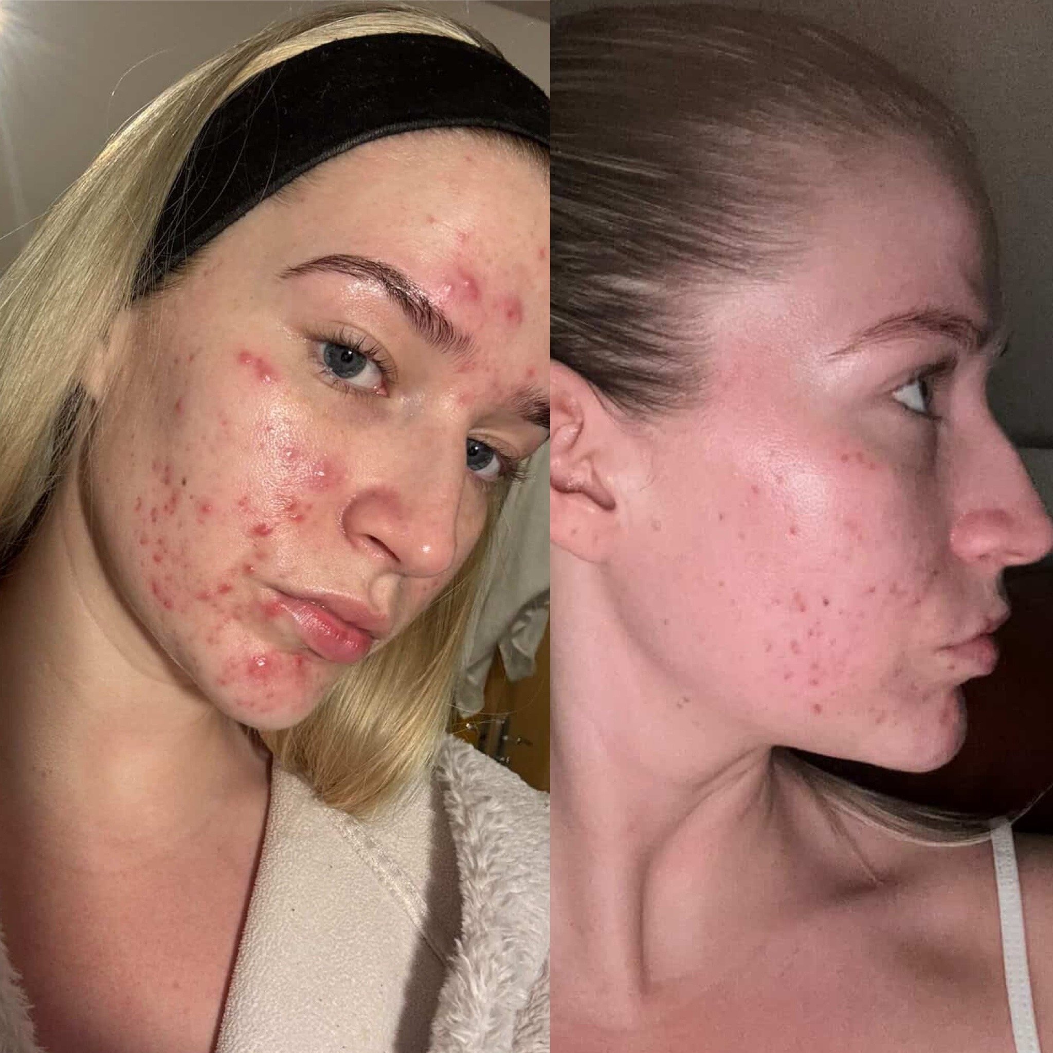 Side-by-side comparison of a woman's face showing acne before and after skin treatment, with clearer skin on the right.