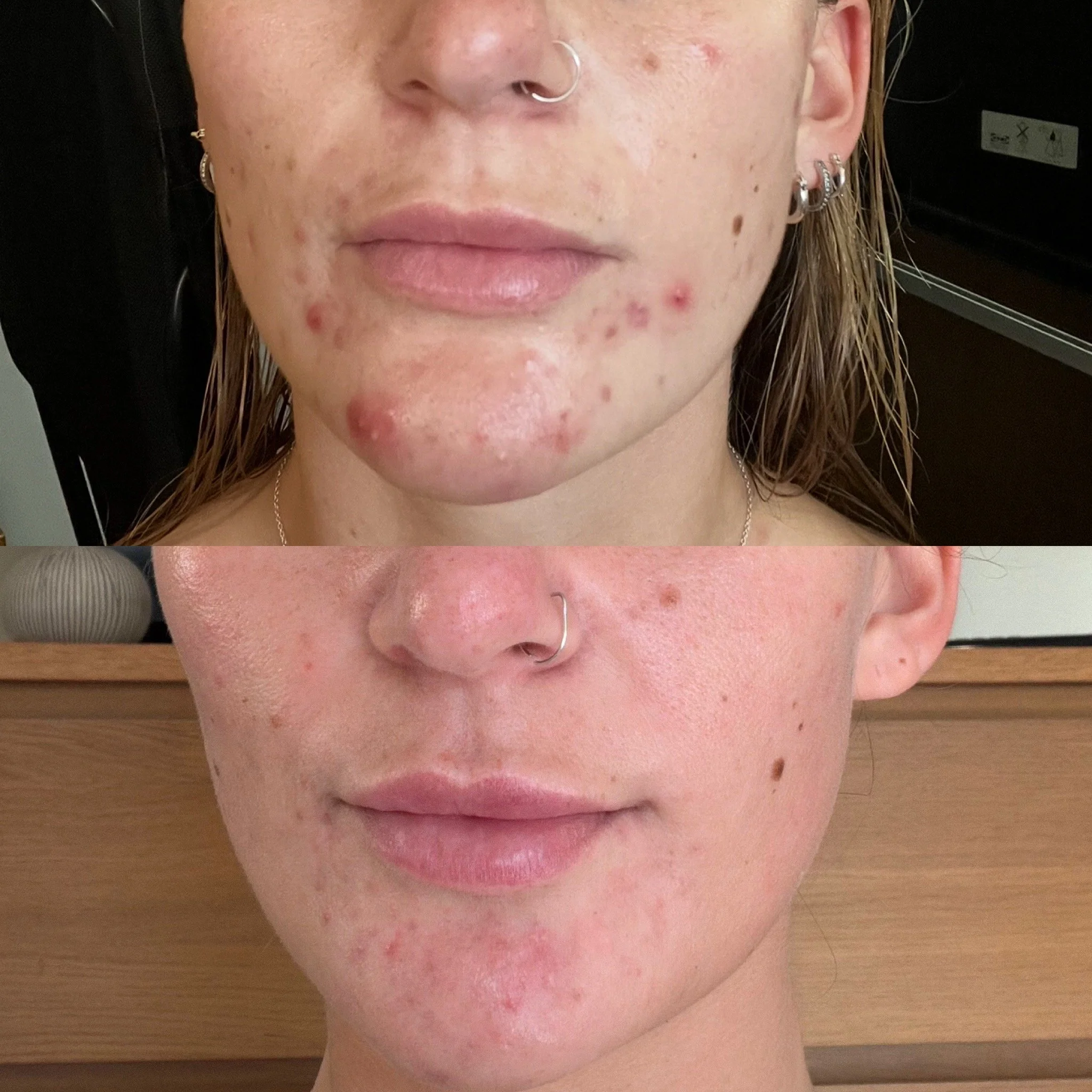 Comparison of a person's face showing acne and skin blemishes in an earlier stage (top) and a clearer skin stage after treatment (bottom).