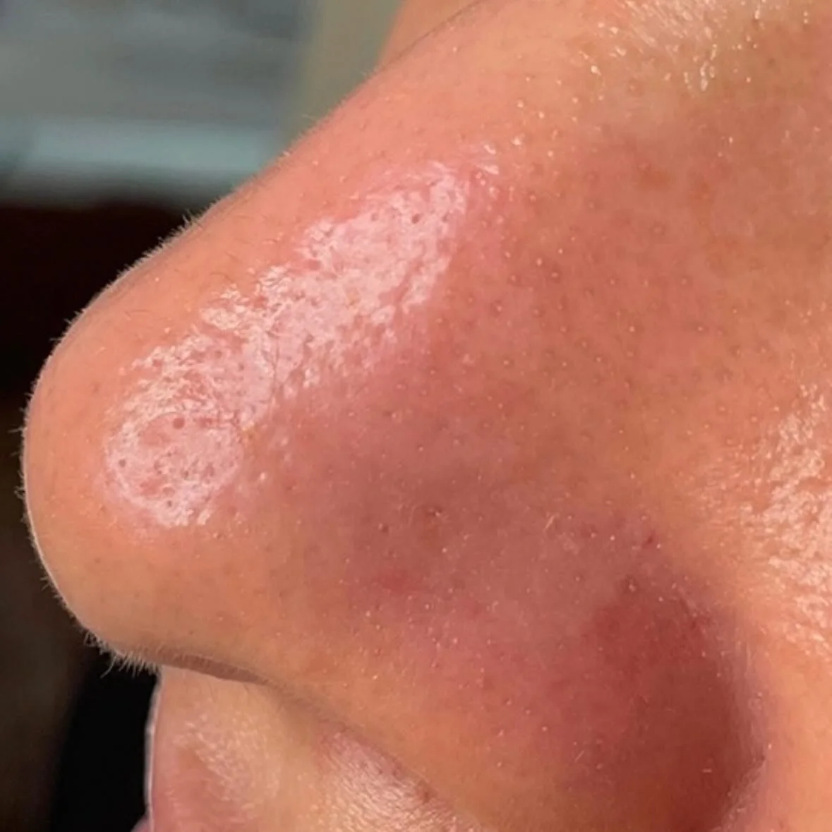 Proven hydrofacial results before and after 😍