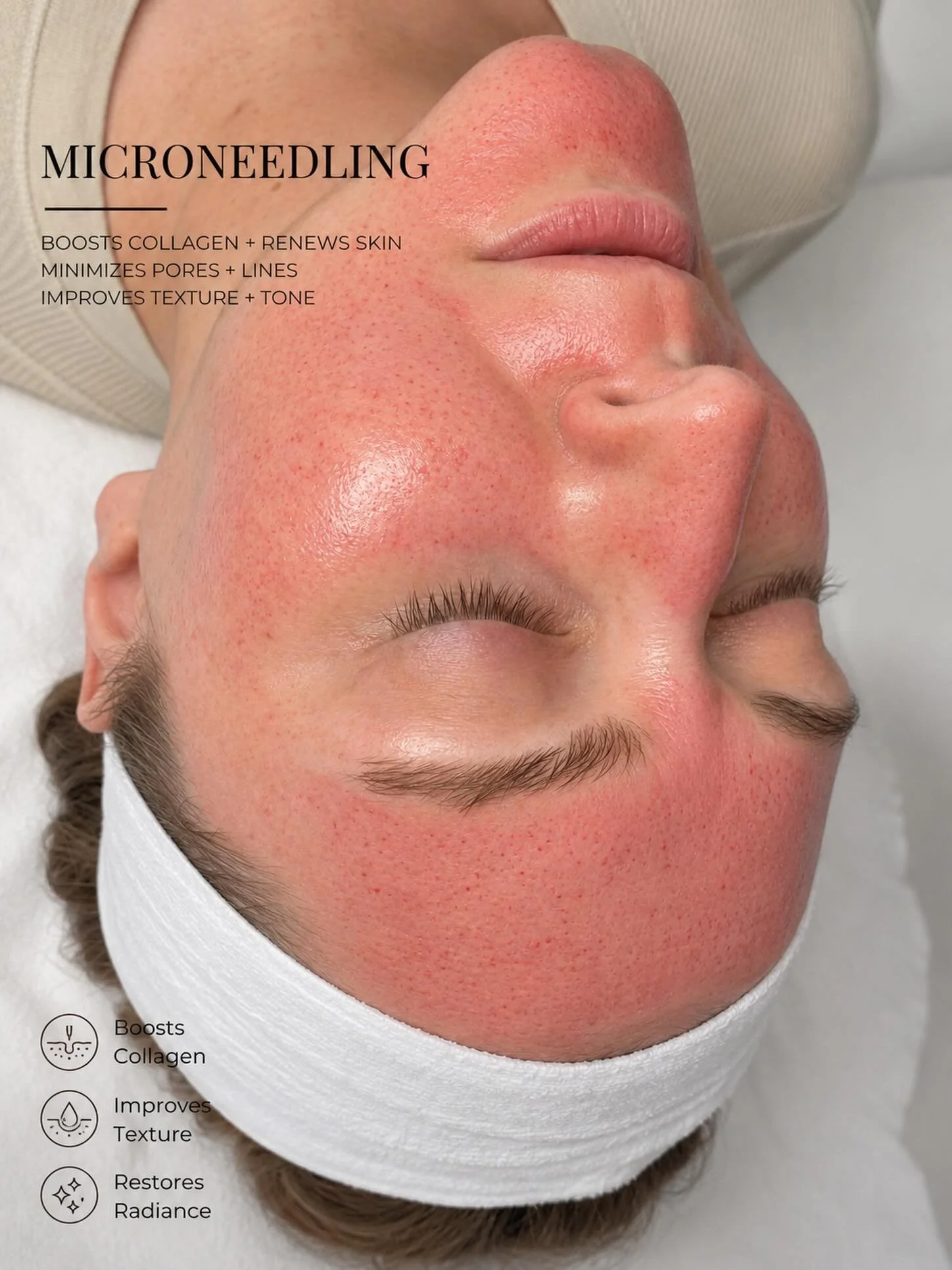 ✨ Microneedling is one of my favorite treatments for improving:
&bull; Acne scars
&bull; Texture
&bull; Fine lines
&bull; Large pores
&bull; Overall skin glow