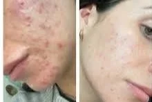 The Truth About Tallow: 5 Common Skincare Myths