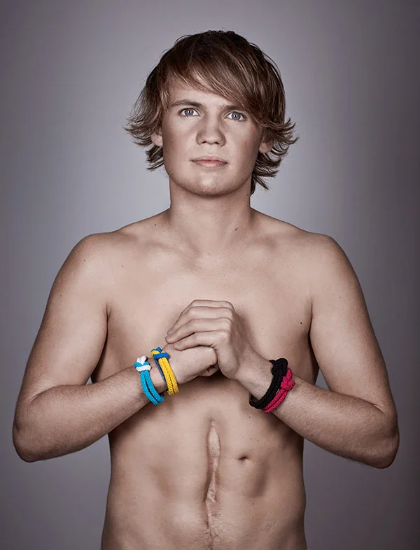 A cancer survivor poses for a portrait showing the scars of this surgery by portrait photographer Jon Enoch