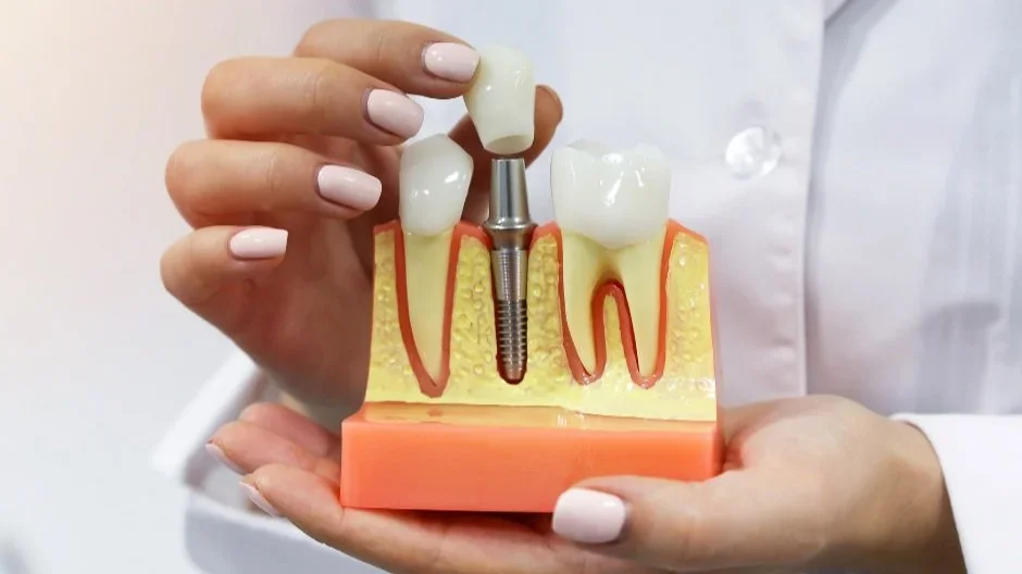 Dental Implant Surgery: Your Complete Guide to Preparation and Aftercare