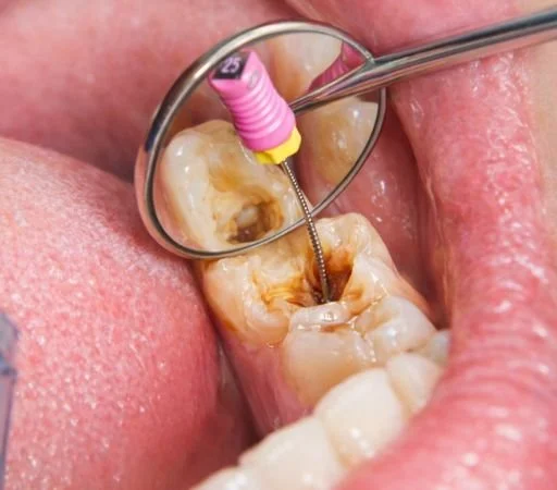 Close-up of root canal treatment removing infected pulp from a molar tooth.