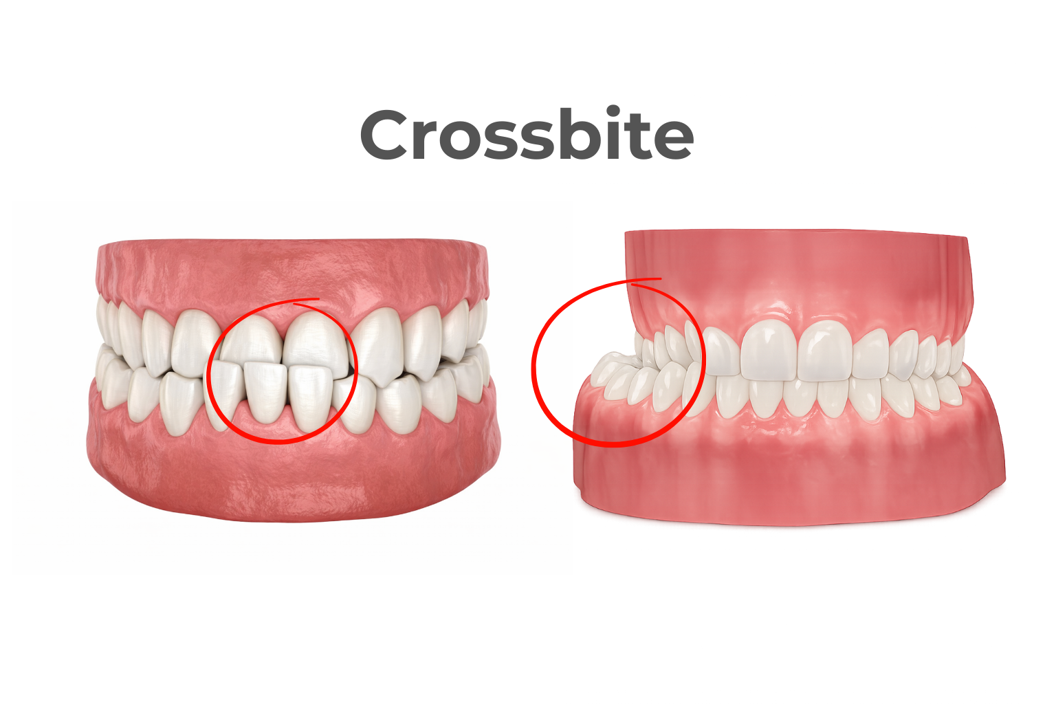 Crossbites: What They Are, Why They Happen, and the Different Types