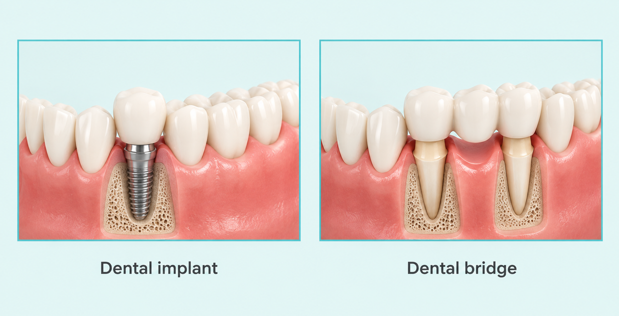 Dental Implants vs. Bridges: Which Is Right for You?