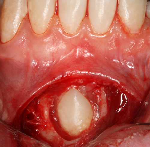 Mandibular canine impacted in the chin