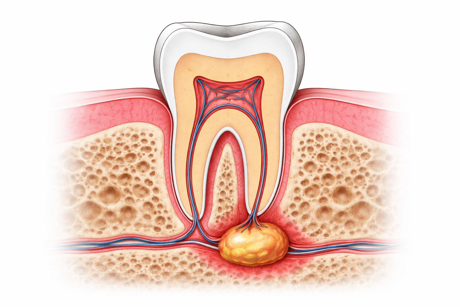 Can a Tooth Abscess Go Away Without Treatment? — iDental Orthodontics ...