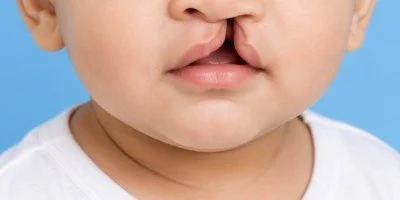 Child with cleft lip