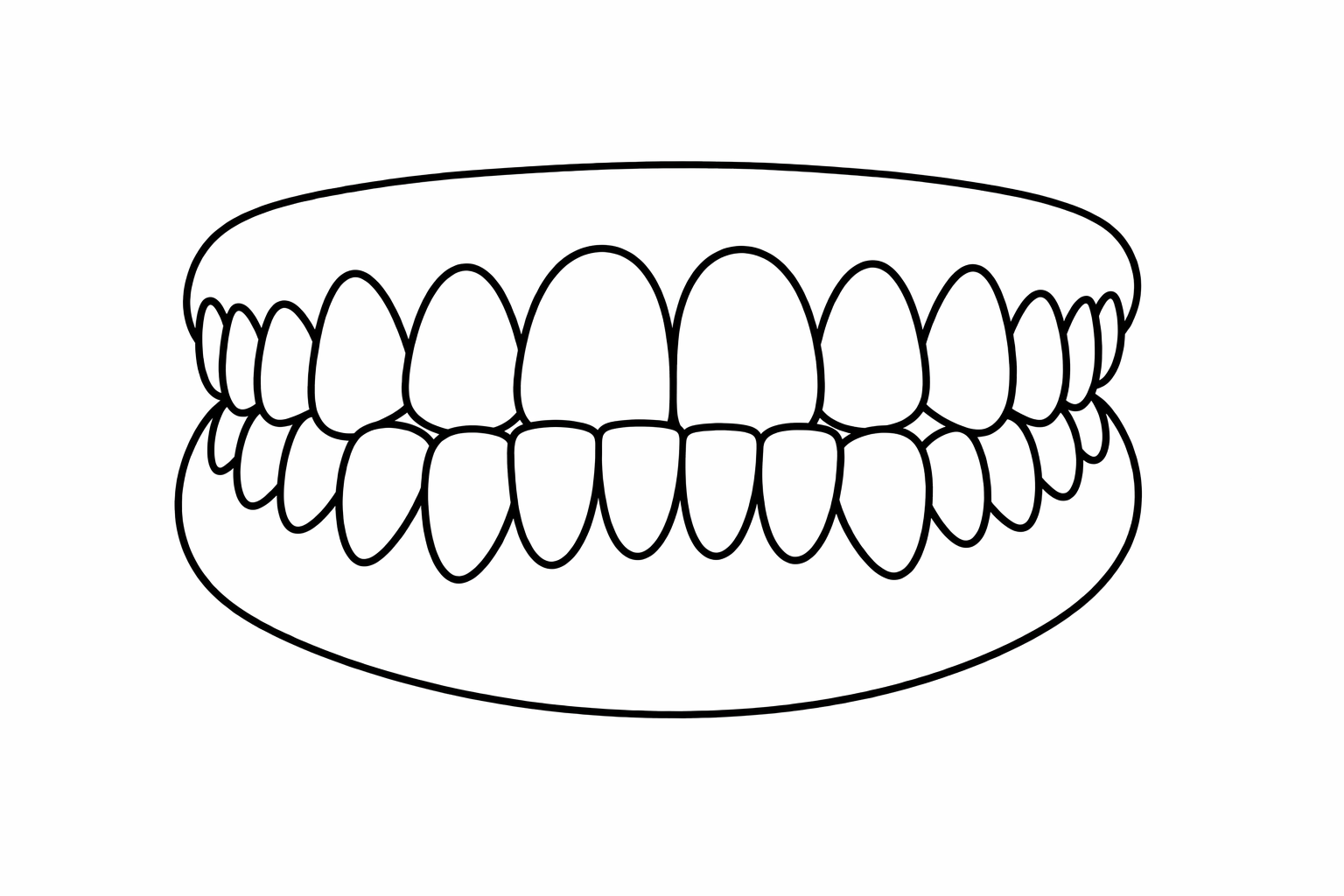 Crossbite illustration