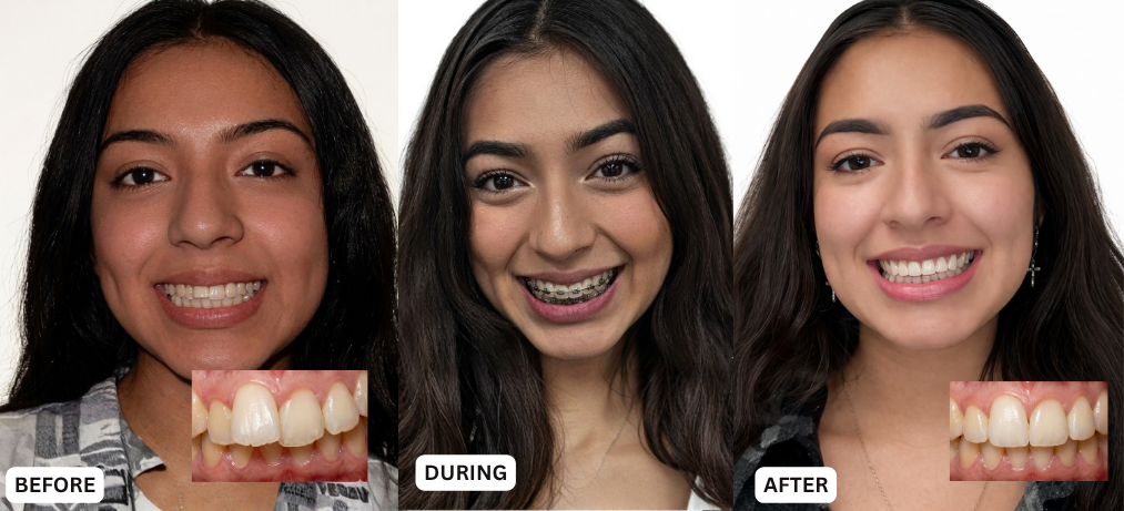 Emilia's braces journey.