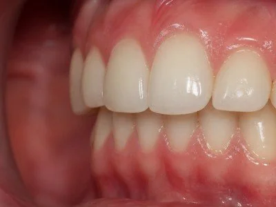 Close up of mouth showing an overbite
