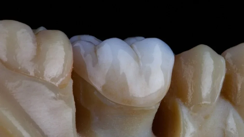 Fast-Track Your Smile: 3D Printed Resin Crowns in One Day!